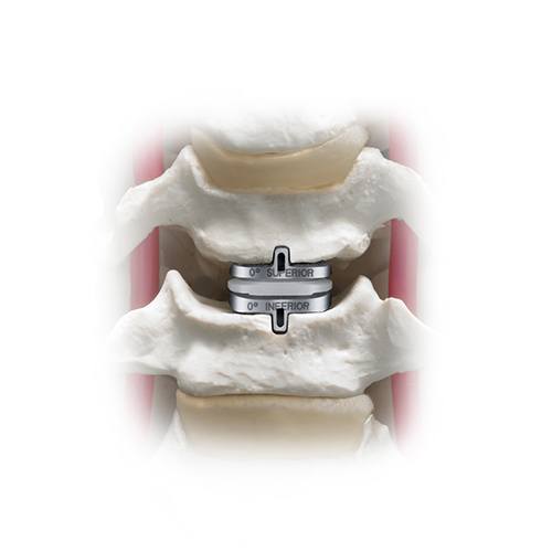 SecureC Anterior Cervical Construct