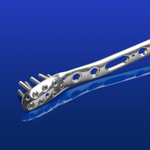 ANTHEM® Ankle Fracture System-Mobile