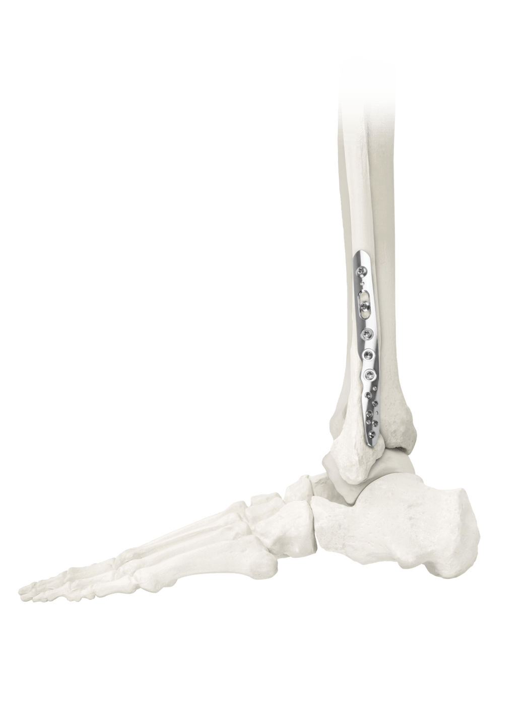 ANTHEM® Ankle Fracture System Final Construct