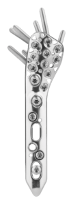 ANTHEM® Proximal Humerus Plate Anterior View