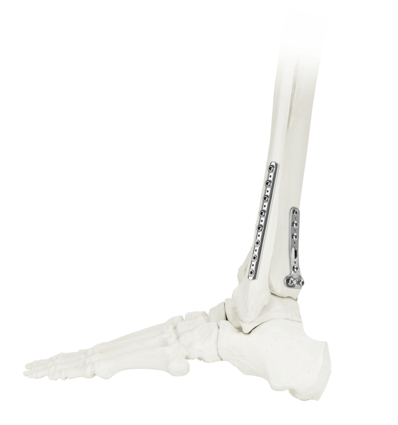 ANTHEM® Small Fragment Fracture System Final Construct