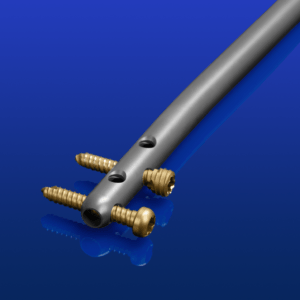 AUTOBAHNTM Tibial Nailing System-Mobile