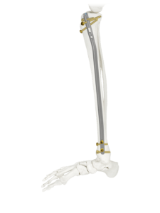 AUTOBAHN® Tibial Nailing System Side View