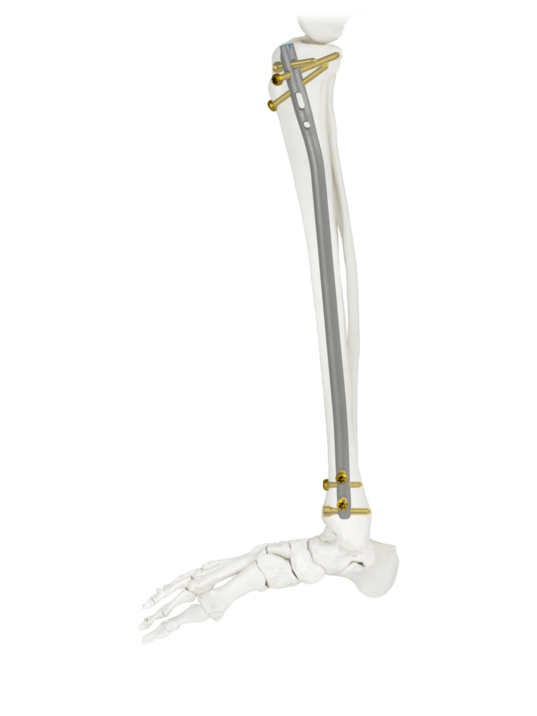 AUTOBAHN® Tibial Nailing System Side View