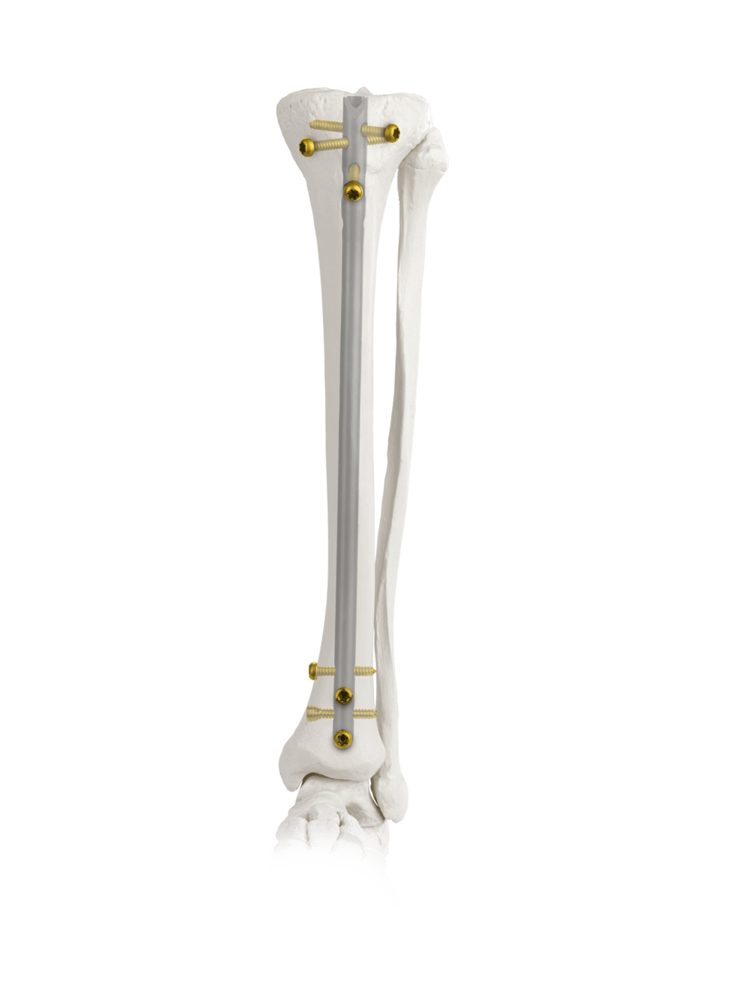AUTOBAHN® Tibial Nailing System | Globus Medical