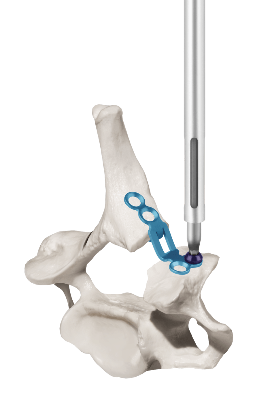 CANOPY Laminoplasty System Plate Insertion