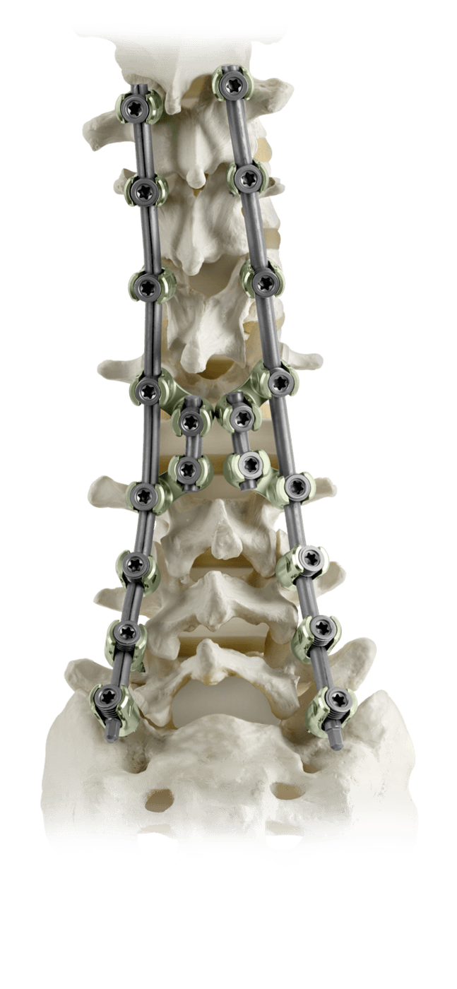 CREO® AMP QUAD™ for Pedicle Subtraction Osteotomy