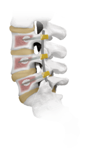 CREO® Fenestrated Lumbar Bone Model