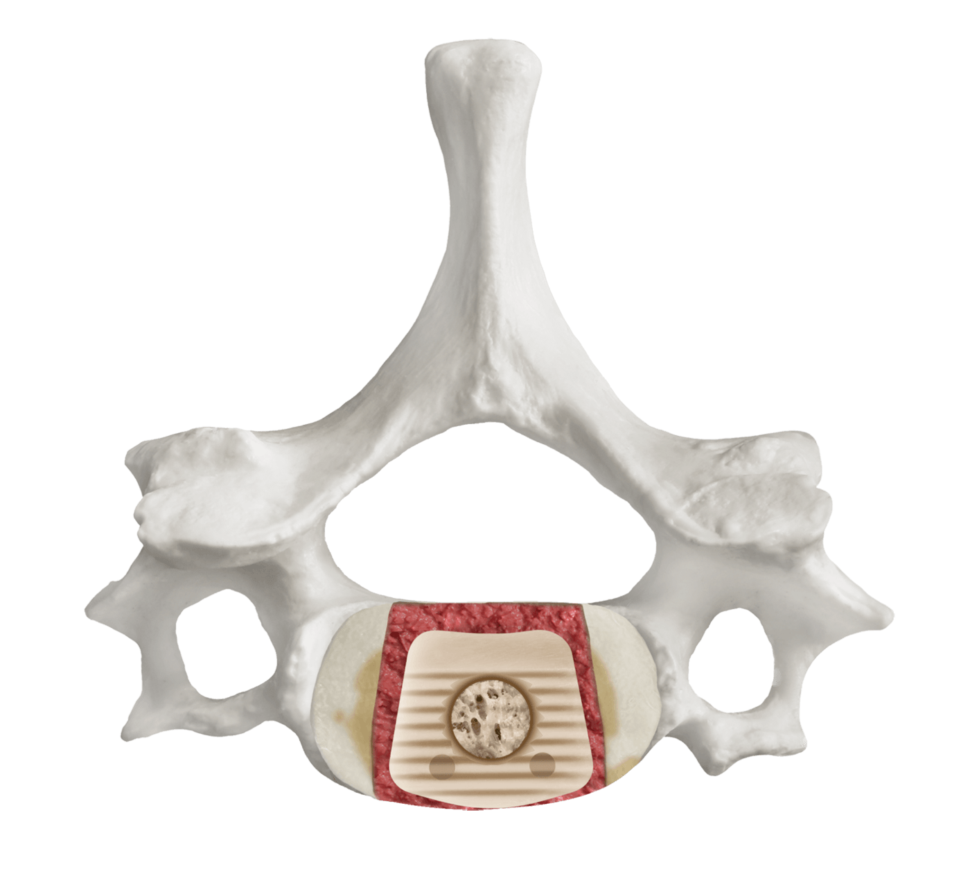 Final Construct of FORGE® Cervical Allograft ACDF Spacer, Axial View
