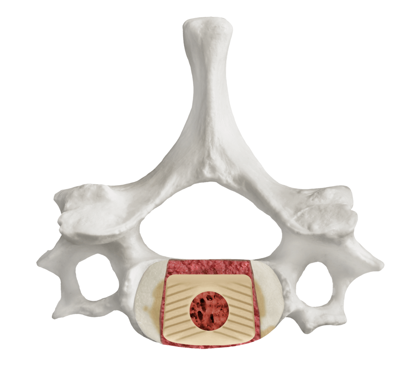 Final Construct of FORGE® Cervical Mono Allograft ACDF Spacer, Axial View