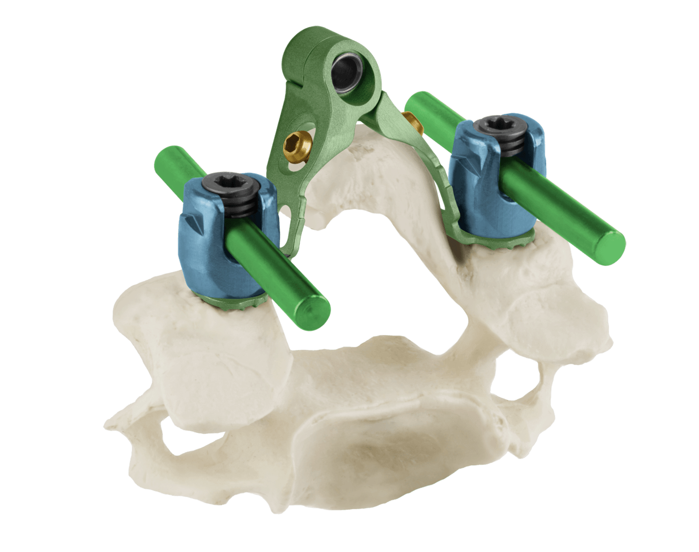 HAVEN® Dual Plate Laminoplasty System with Quartex, Oblique Axial View