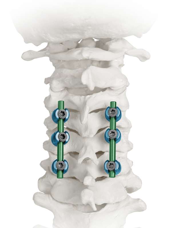 Posterior Cervical Screws and Rods