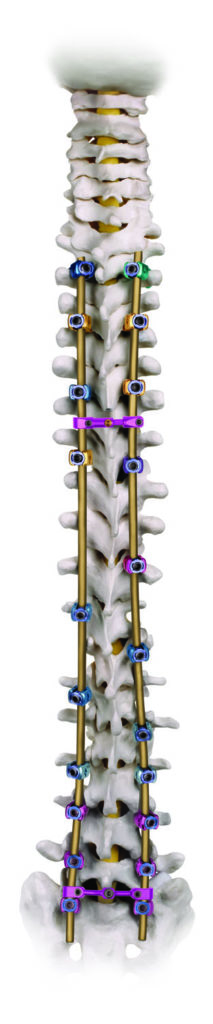 REVERE Scoliosis Deformity Correction