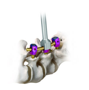 REV635 medical tech