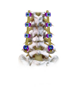 REVERE Corrective Osteotomy Posterior Construct View