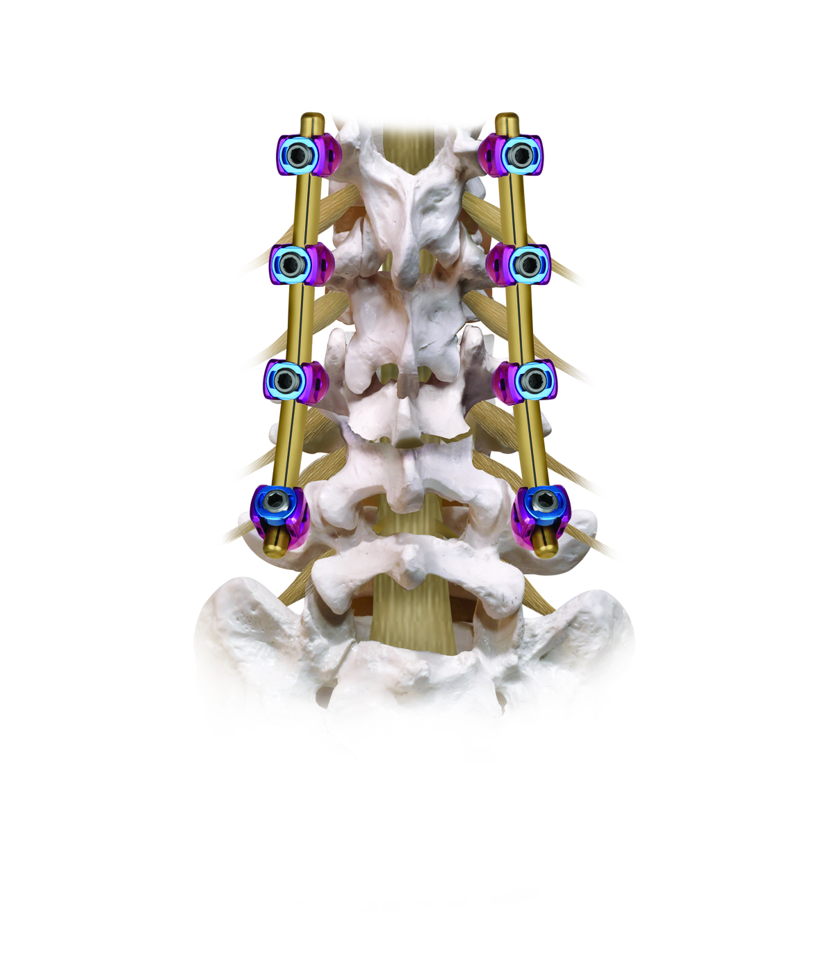 REVERE Corrective Osteotomy Posterior Construct View