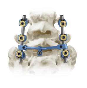 Fully Constructed REVERE® Thoracolumbar Stabilization System