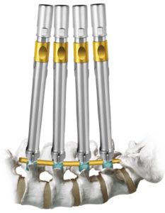 REVOLVE® Low Profile Stabilization System