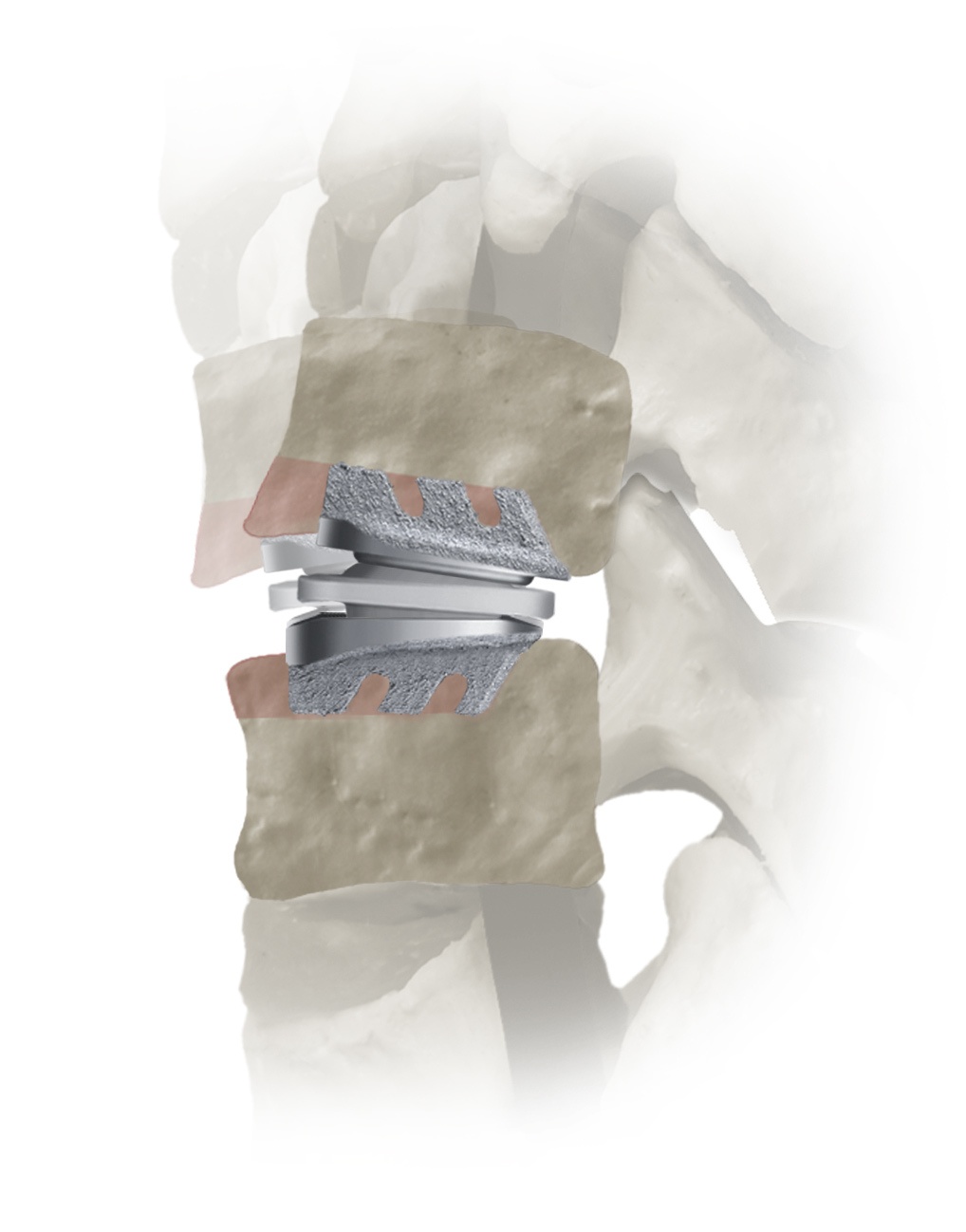 SECURE-C® Cervical Artificial Disc Globus Medical