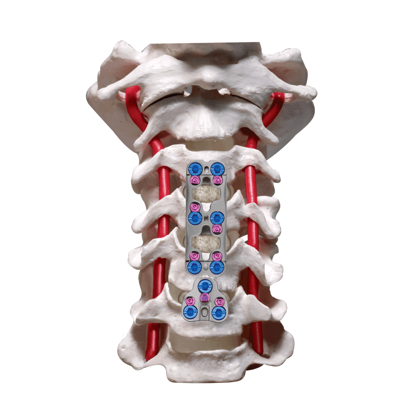 XTEND® Anterior Cervical Plate with Universal Extender Final Construct