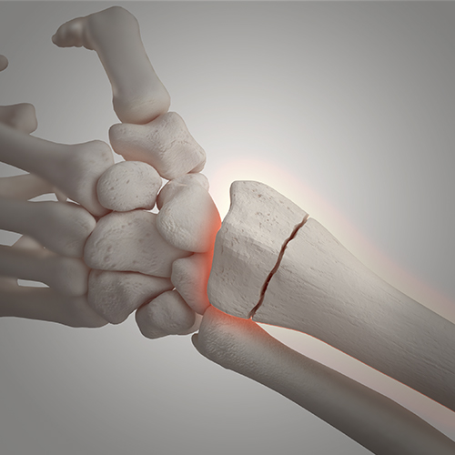 distal radius fracture