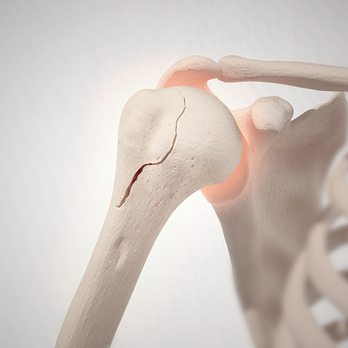 proximal humerus fracture