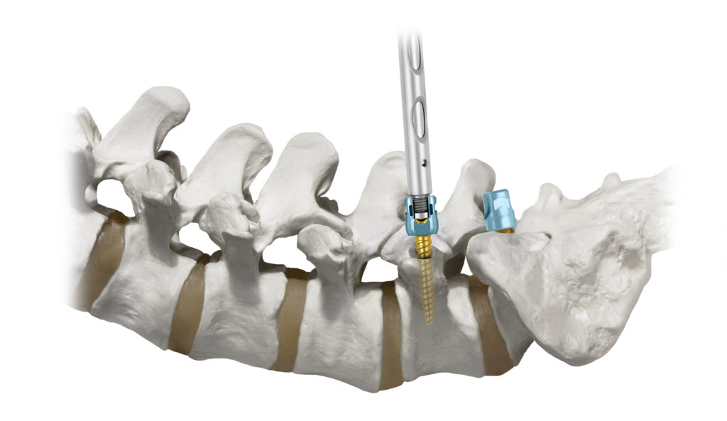 CREO Screw Insertion