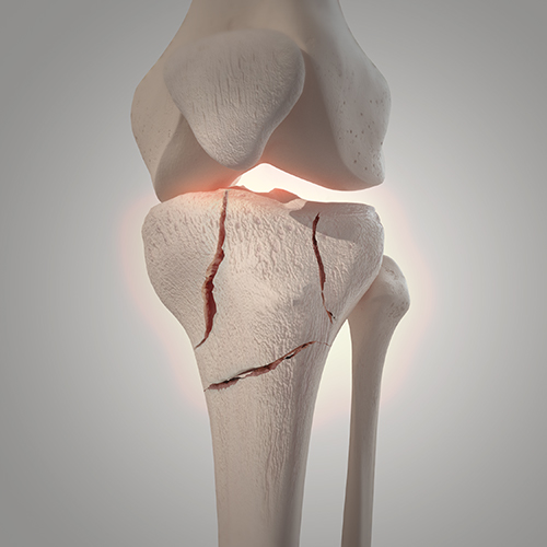 tibia fracture