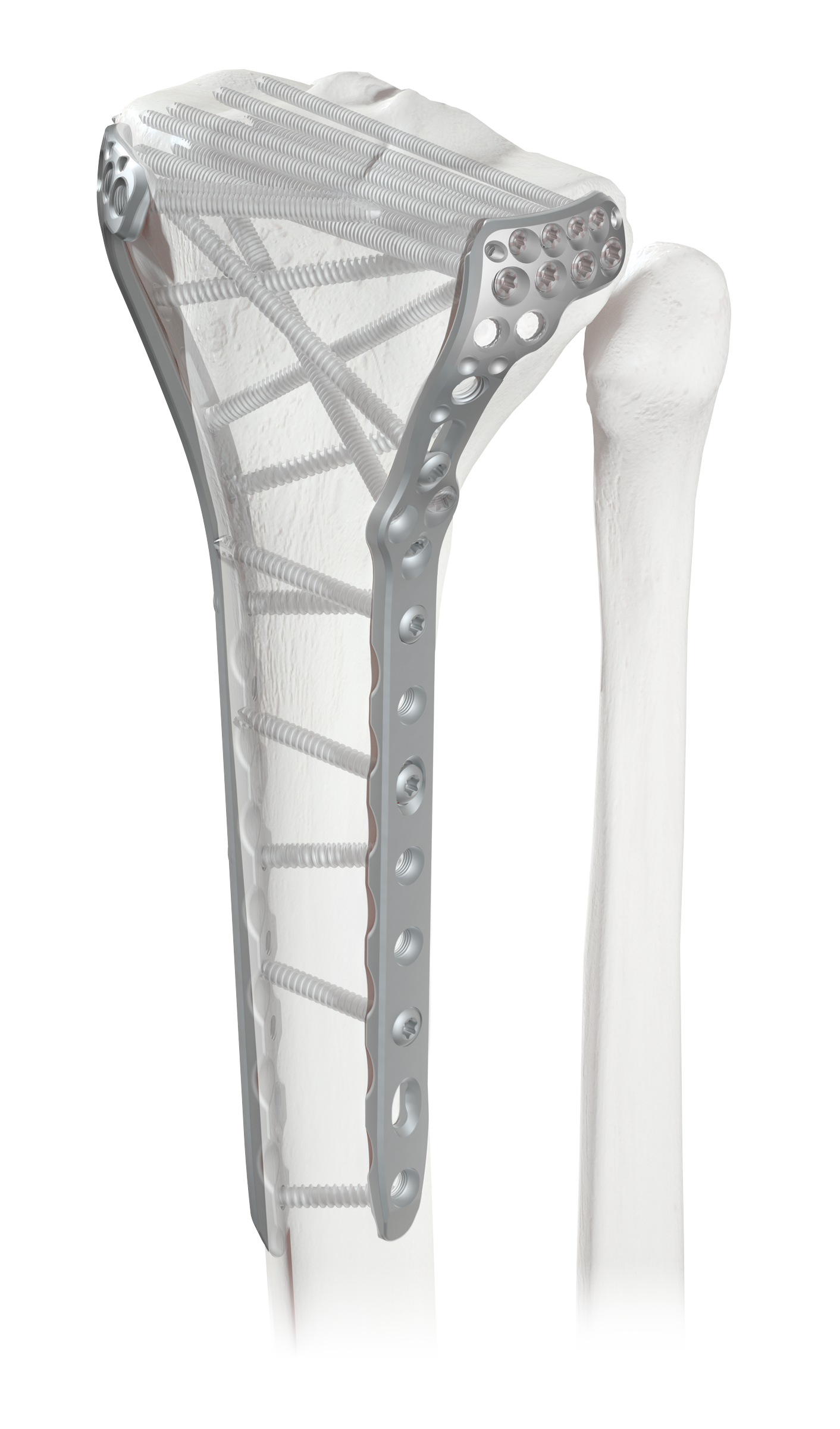 ANTHEM® Proximal Tibia Fracture System Globus Medical