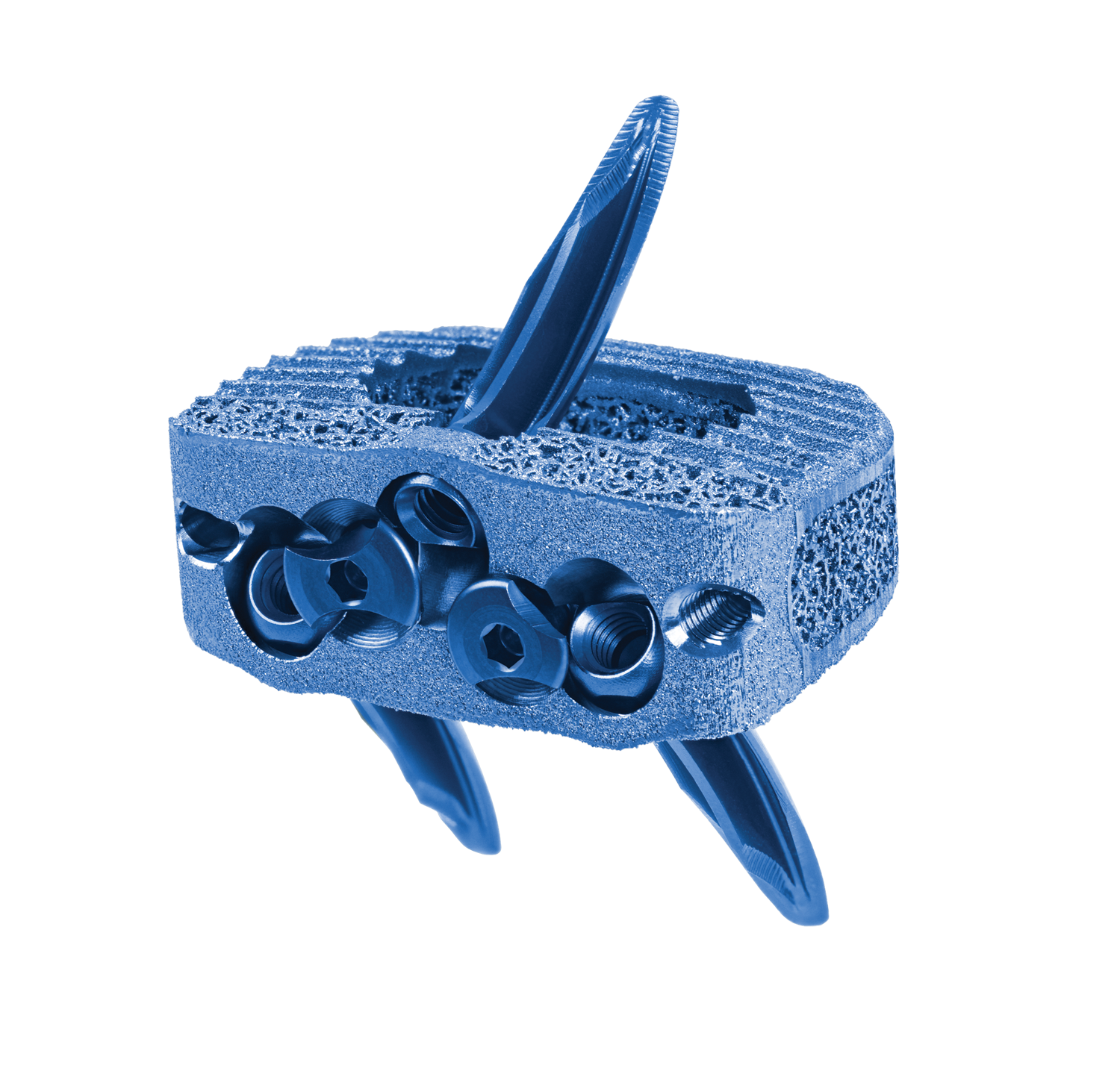 HEDRON IA Spacer with anchors