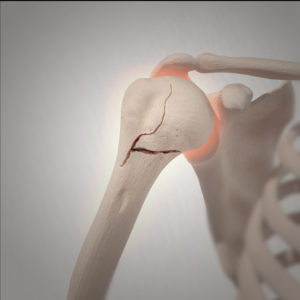 Proximal humerus fracture