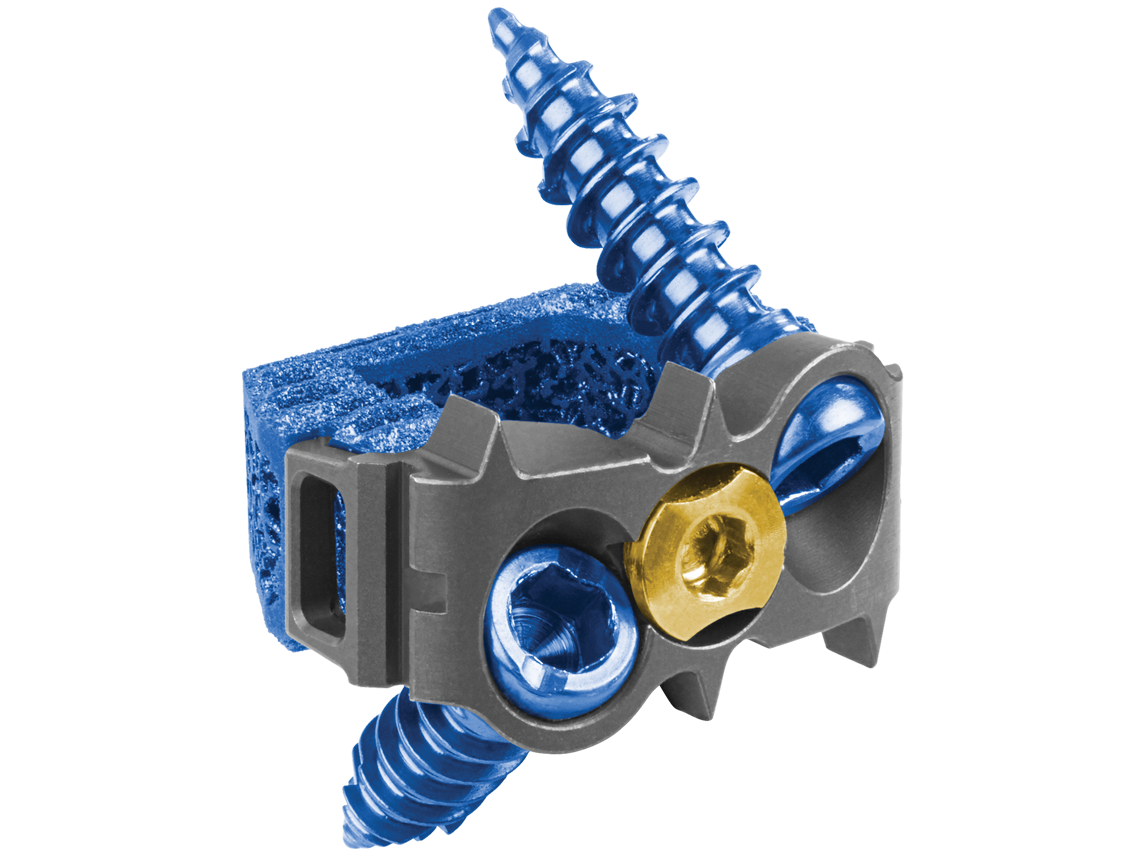 HEDRON IC® 3D Printed Integrated ACDF PlateSpacer Globus Medical