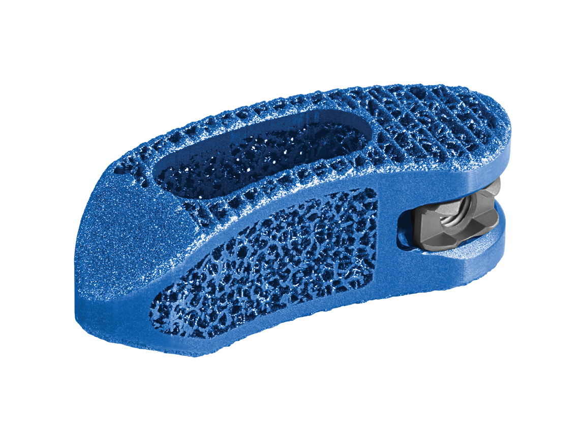 HEDRON T™ 3D Printed TLIF spacer | Globus Medical