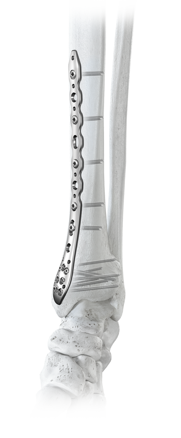 ANTHEM® Distal Tibia Fracture System Globus Medical