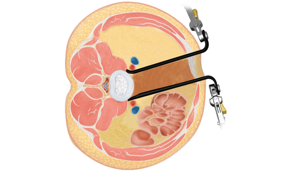 MARS™ Lateral ALIF Retractor | Globus Medical