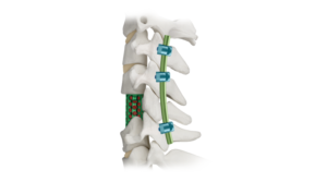 Implant in spine with supplemental fixation