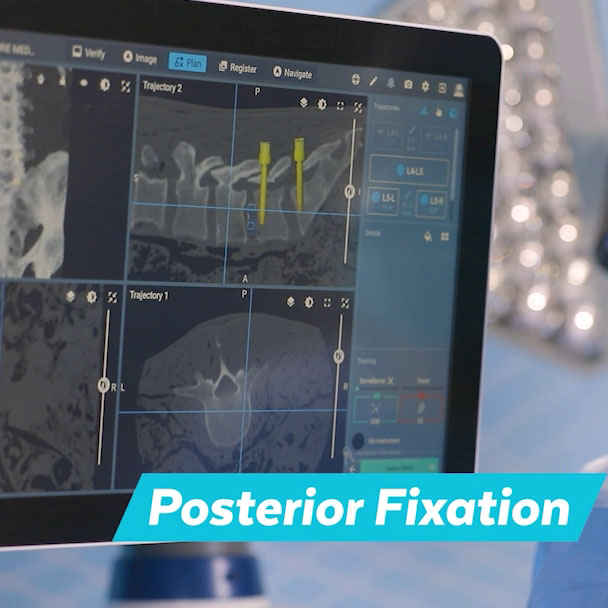 Excelsius Lateral 360 Posterior Fixation