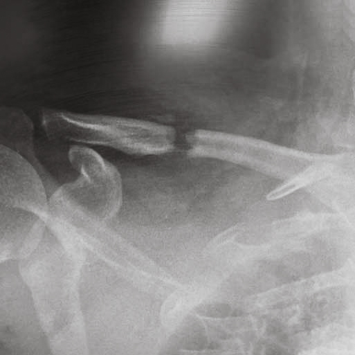 X-ray showing a fracture