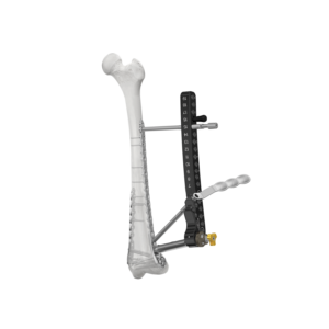 ANTHEM Distal Femur
