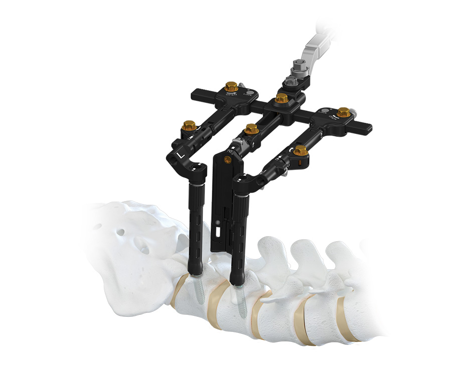 MARS TLIF Retractor with spine