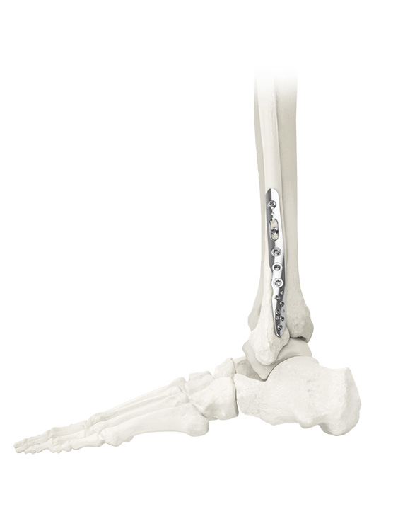 ANTHEM Ankle Fracture plate on bone