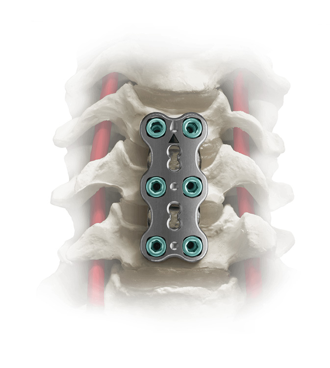 Assure® Anterior Cervical Plates Globus Medical