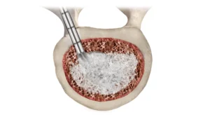 Vertebral augmentation thumbnail