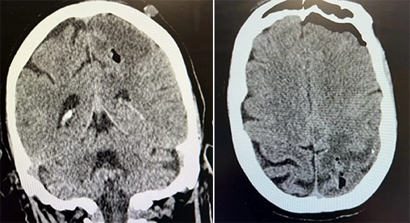 Postoperative CT