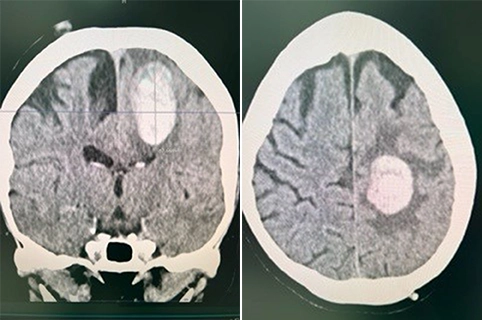 Pre-op CT