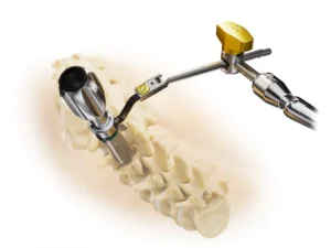 NuVasive Tube System