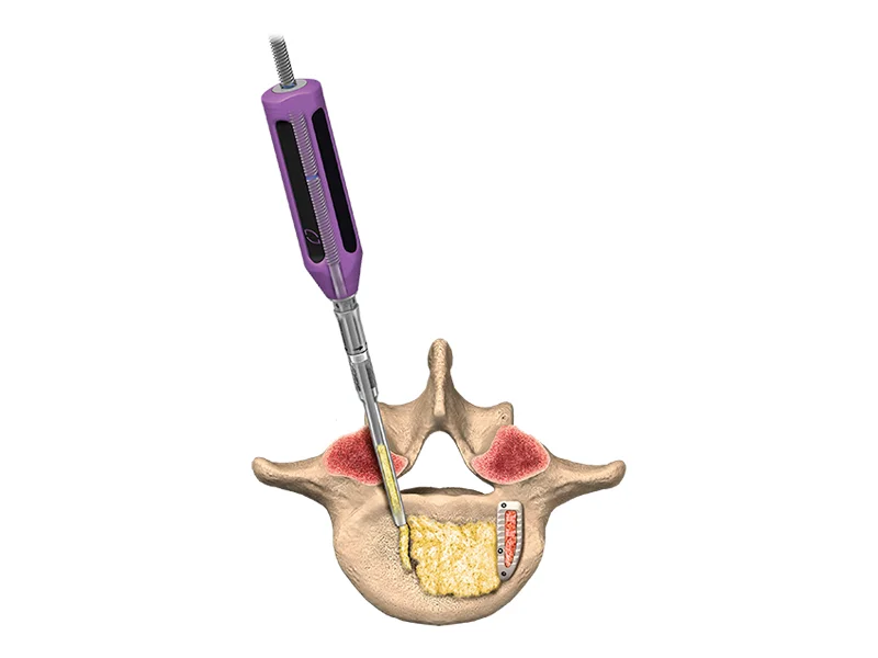 Graft Delivery System
