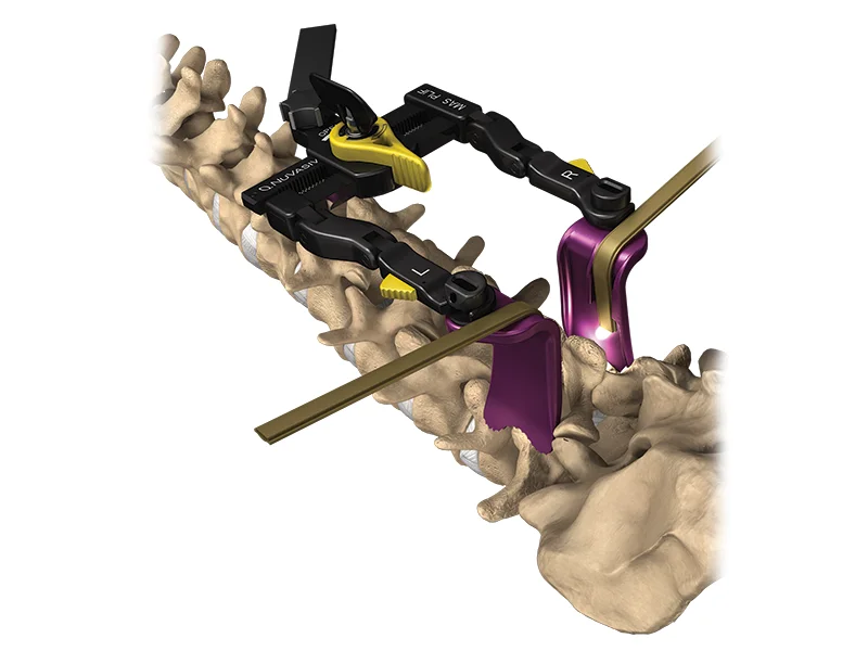 MAS Midline System