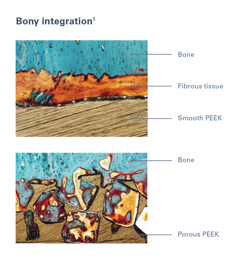 Bony integration chart