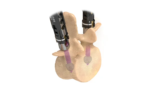Reline Fenestrated